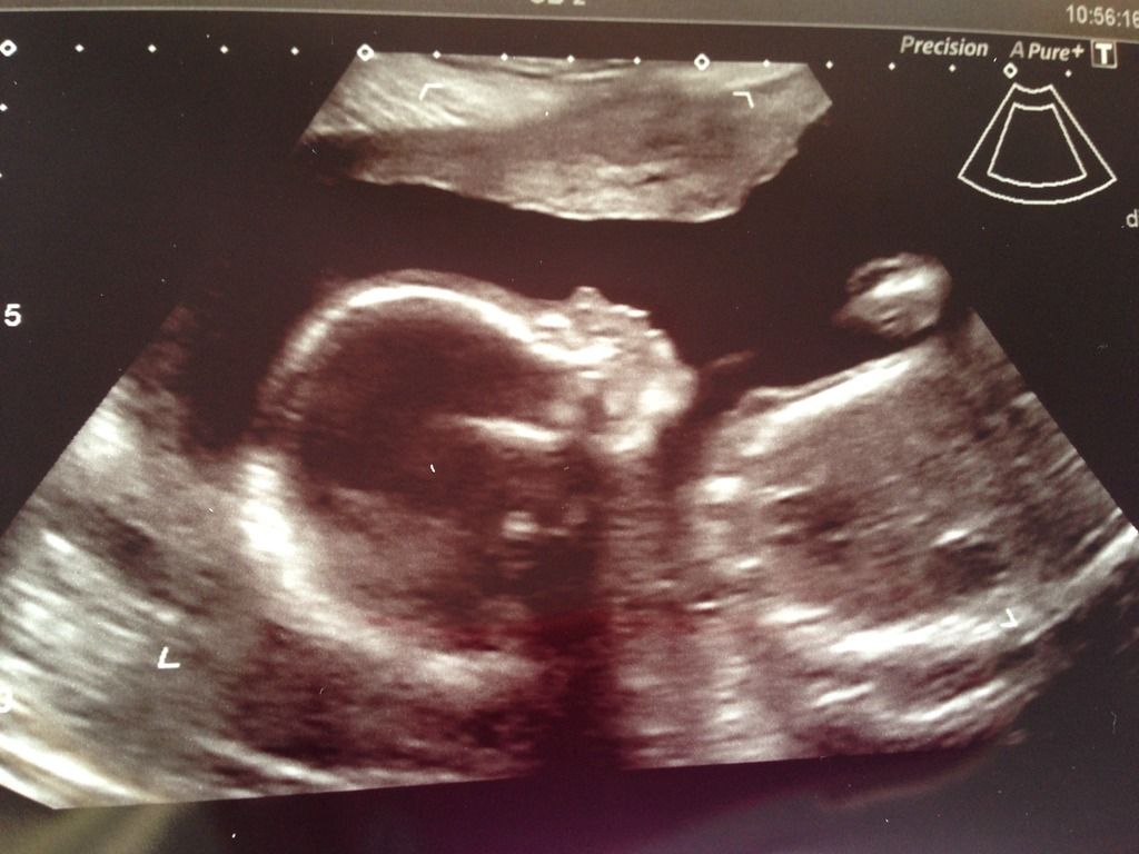 posterior-low-lying-placenta-at-20-week-scan-worried-gender-pic